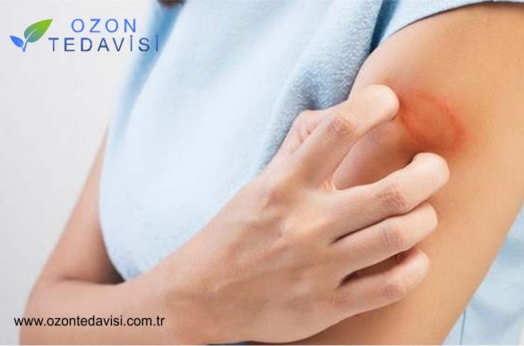 Cilt Mantarları ve Enfekte Cilt Lezyonları